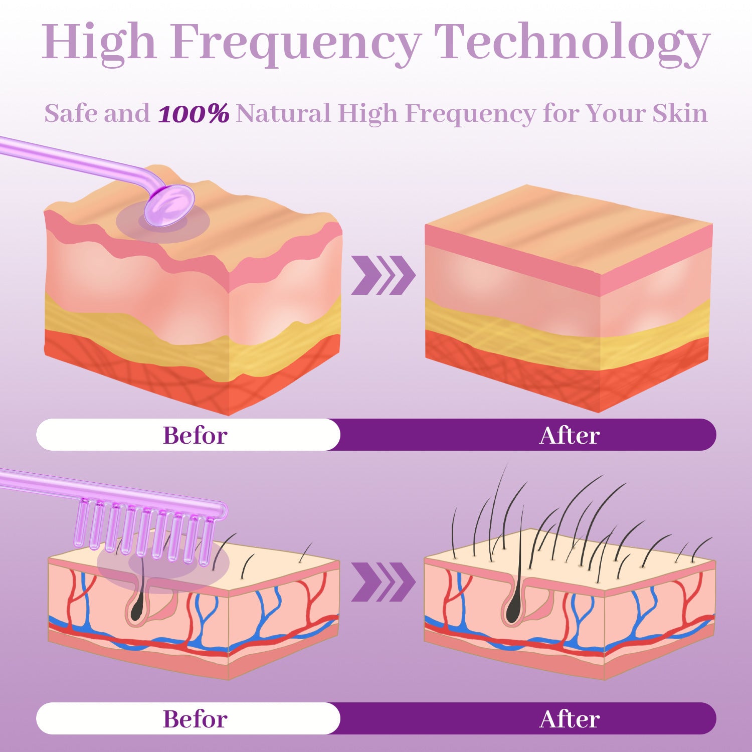 High Wave Electrotherapy Rod High Frequency Beauty Instrument Eutic Appliance